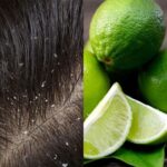 Tips Ampuh Mencegah Ketombe Kembali dengan Mudah: Rahasia Rambut Sehat dan Bersih