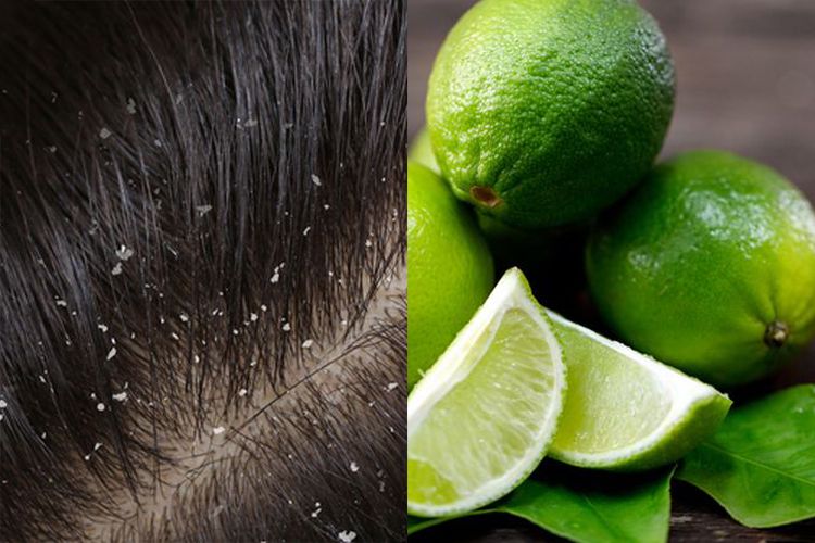 Cara Menghilangkan Ketombe pada Rambut Kering: 12 Tips Efektif untuk Hasil Maksimal