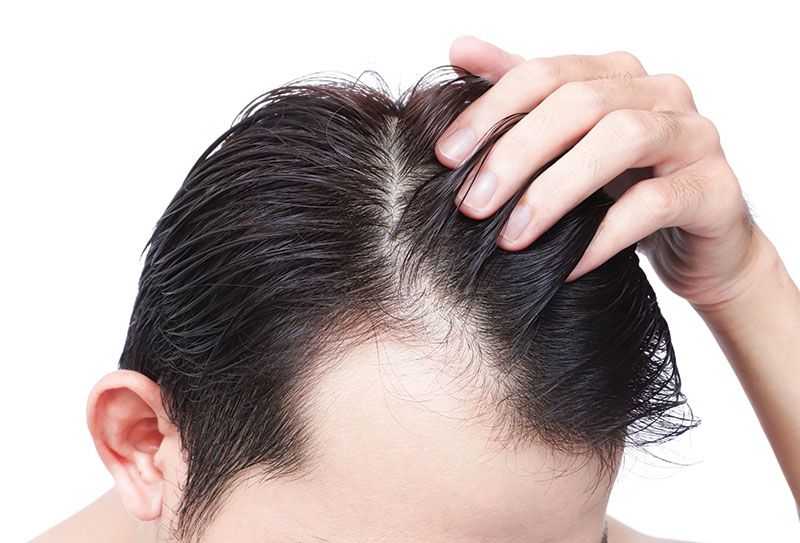 Rambut Rontok Karena Stres? Tenang, Atasi dengan Cara Ini!