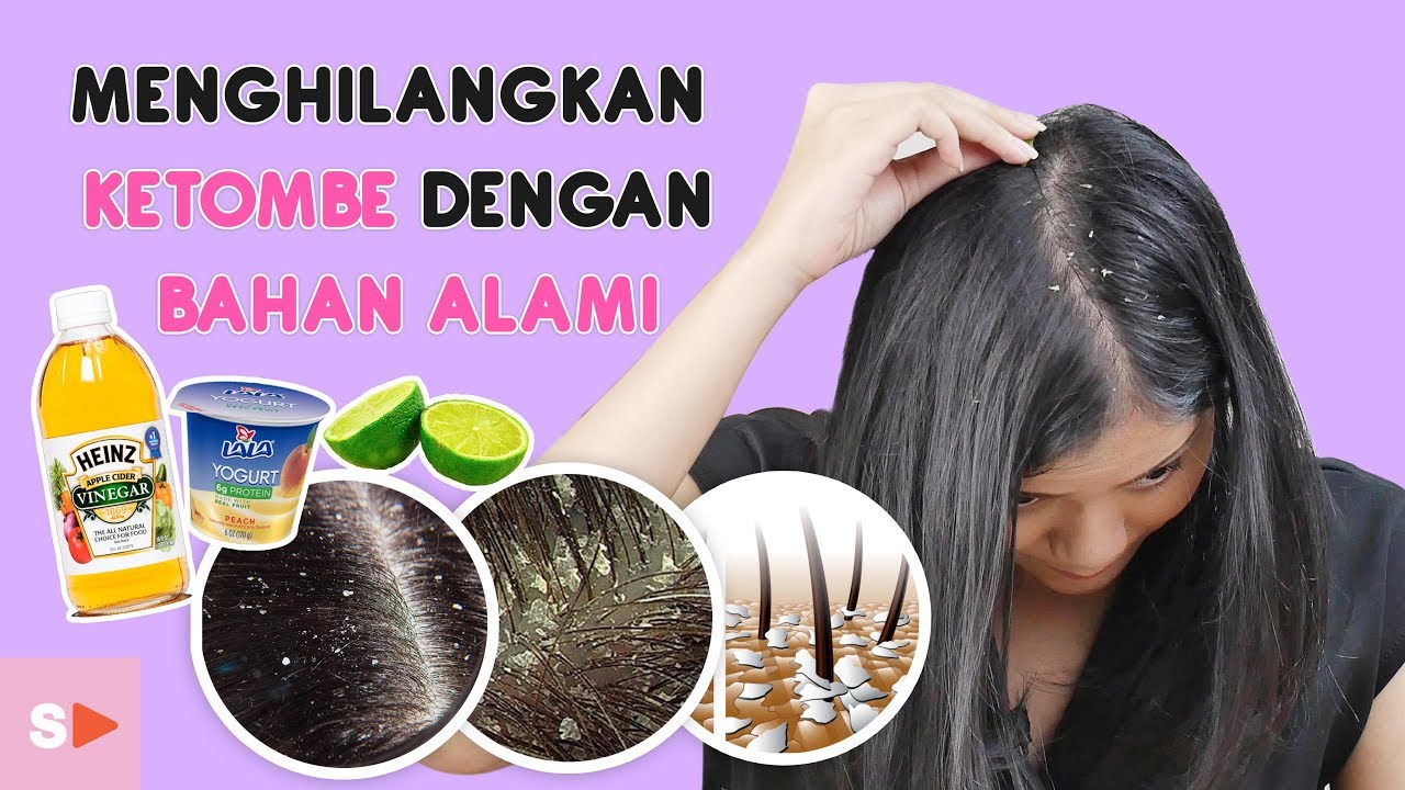 Selamat Tinggal Ketombe, Halo Rambut Sehat! Solusi Alami untuk Atasi Masalah Kulit Kepala