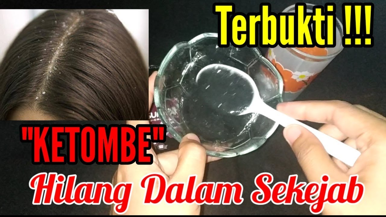 Solusi Ampuh Mengatasi Ketombe pada Rambut Kering: Atasi Permasalahan Kulit Kepala dan Kembalikan Keindahan Rambutmu!