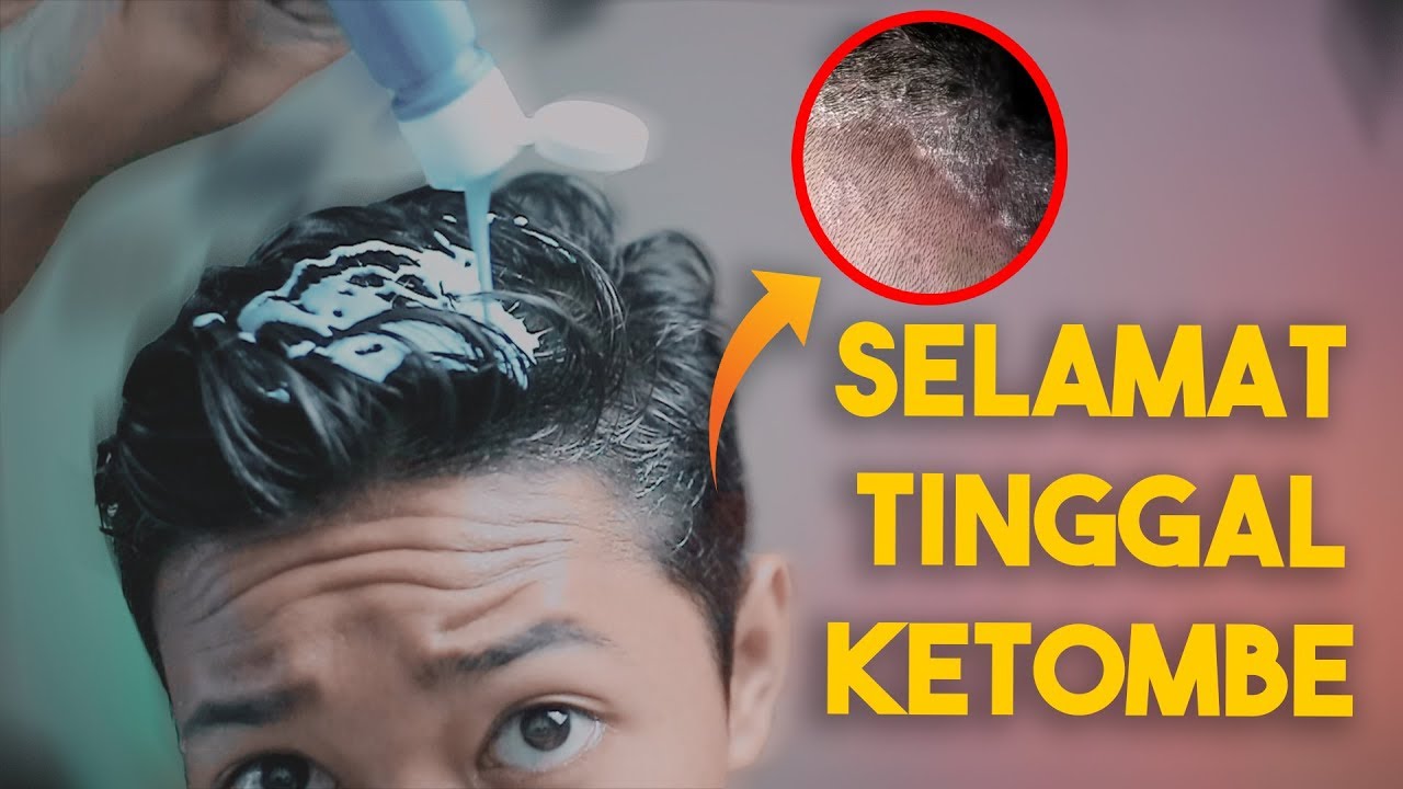 Bosan dengan Ketombe yang Membandel? 12 Obat Ini Bisa Jadi Solusi!