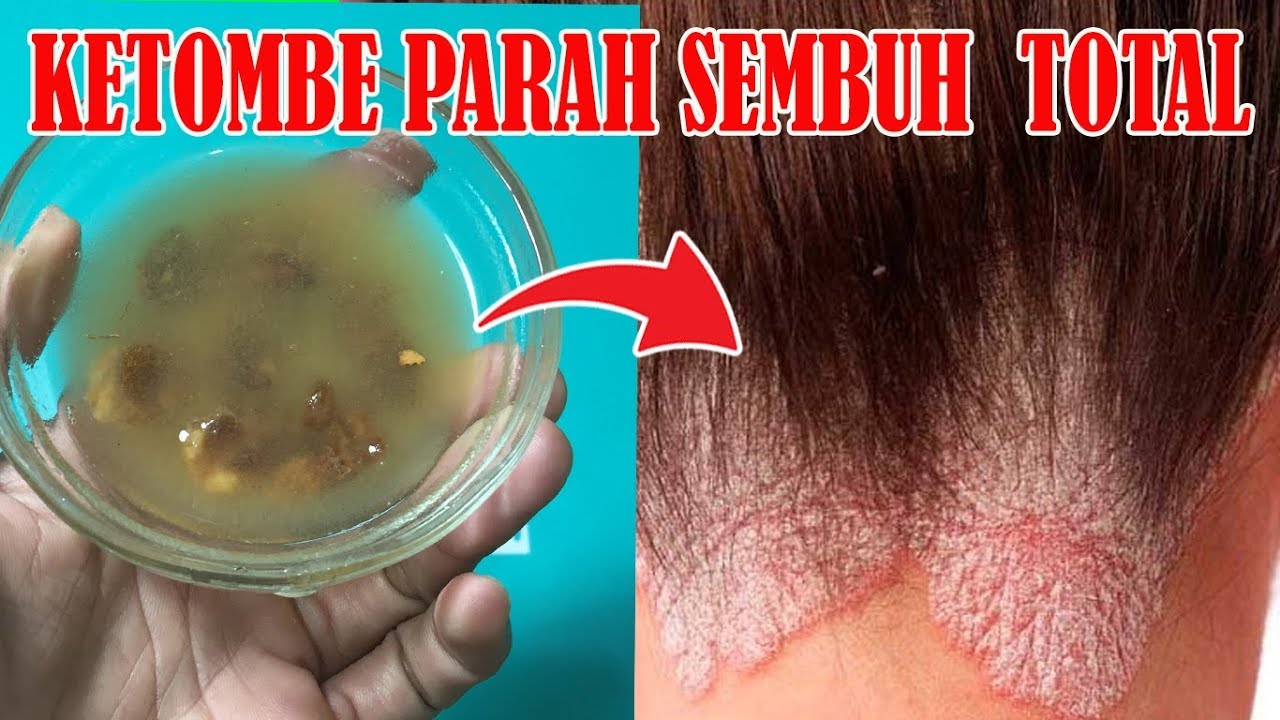 Bosan dengan Ketombe yang Membandel? 12 Obat Ini Bisa Jadi Solusi!