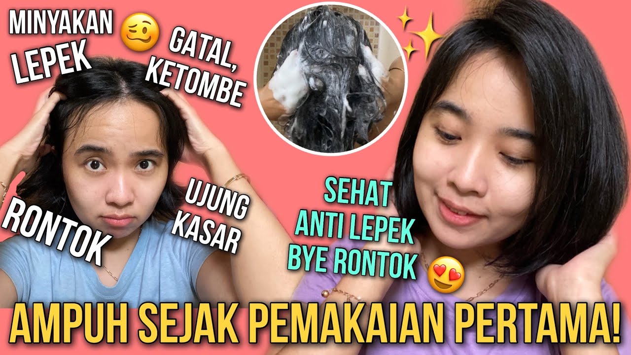 Rambut Rontok karena Ketombe? Tenang, 12 Solusi Ampuh Ini Bisa Membantu!