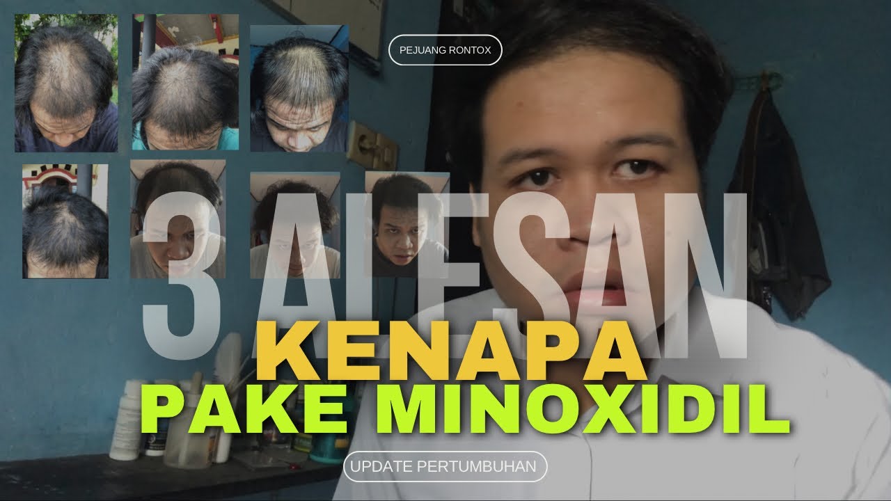 Rambut Rontok di Usia Muda: 12 Faktor yang Mungkin Tak Terduga!