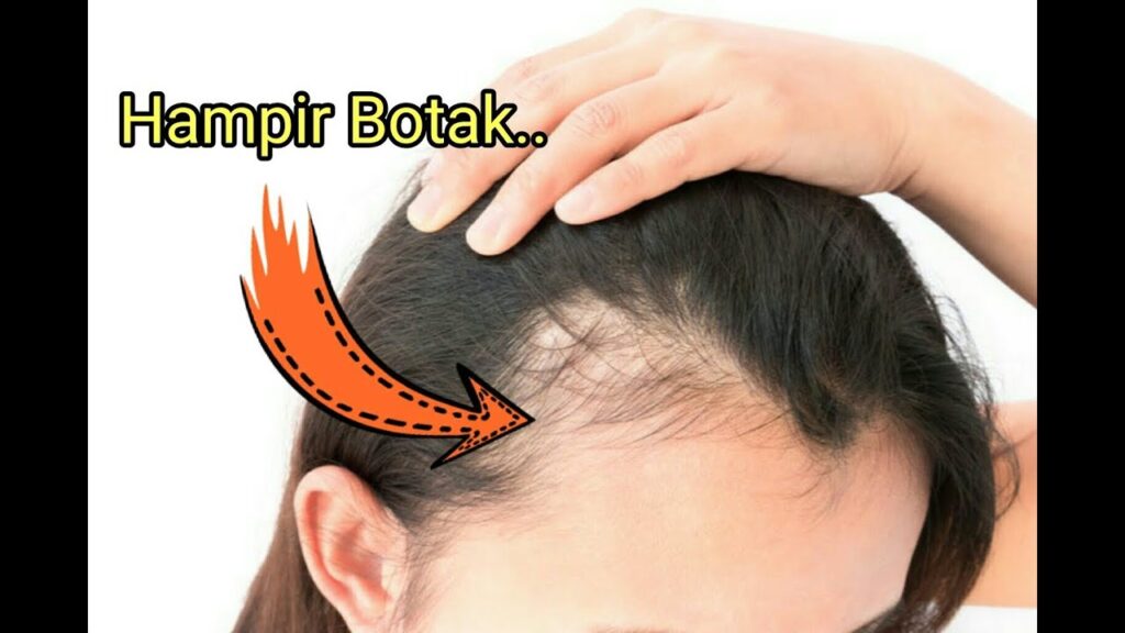 Rambut Rontok Tak Terkendali? Vitamin C Jadi Solusi Ajaibku!