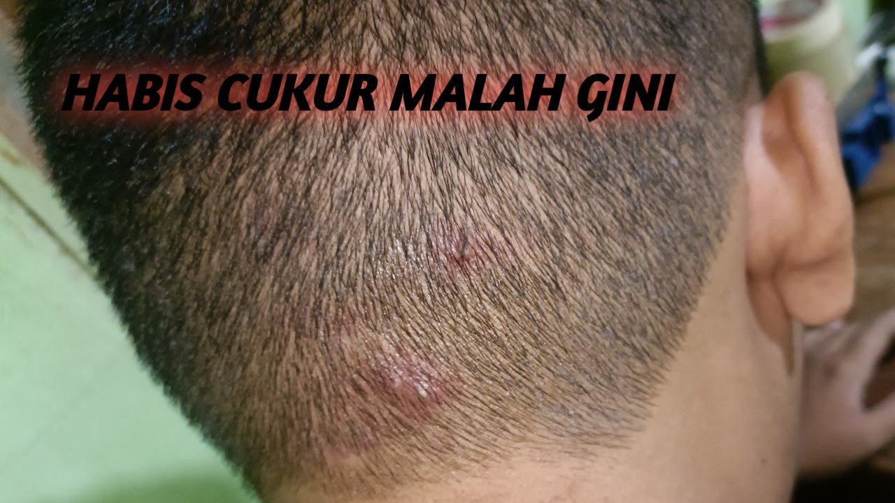 Apakah Rambut Panjang Menyebabkan Jerawat? Mitos atau Fakta?