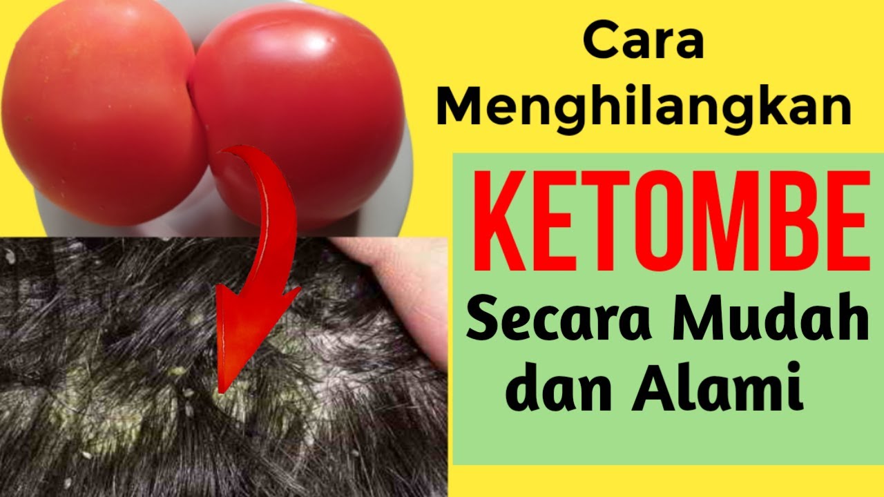 Cara Efektif Mengatasi Ketombe Akibat Diet: Atasi Permasalahan Kulit Kepala dengan Tepat