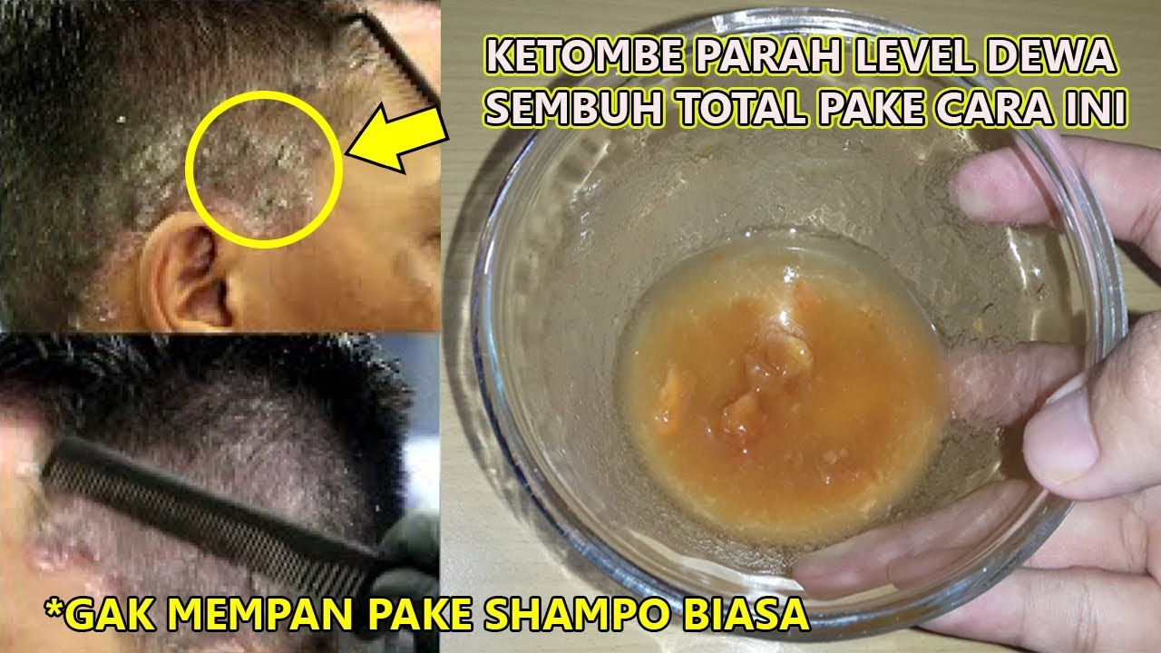 Hilangkan Ketombe Kering Secara Alami: Panduan Lengkap Tanpa Obat