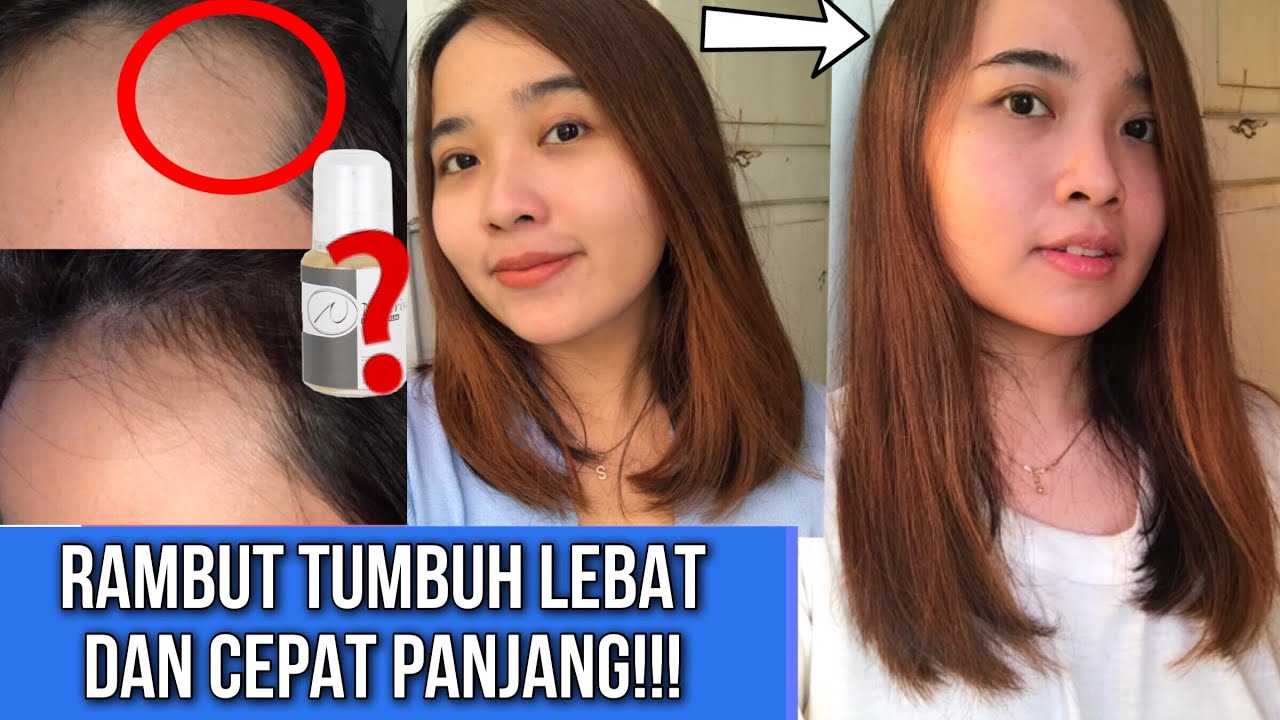 Apakah Rambut Gundul Bisa Tumbuh Kembali? Menyingkap Misteri Kebotakan