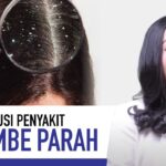 Ketombe di Kulit Kepala Berminyak: Penyebab dan Solusi Tepat