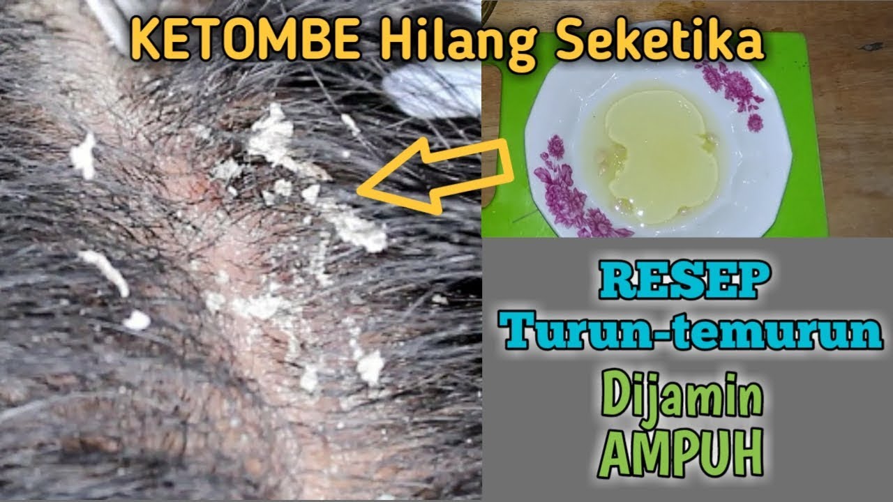 Cara Ampuh Mengatasi Ketombe Akibat Stres dengan Bahan Alami