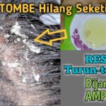 Pertempuran Panjang Mengalahkan Ketombe Menahun: Kisah Perjalanan Menuju Rambut Sehat