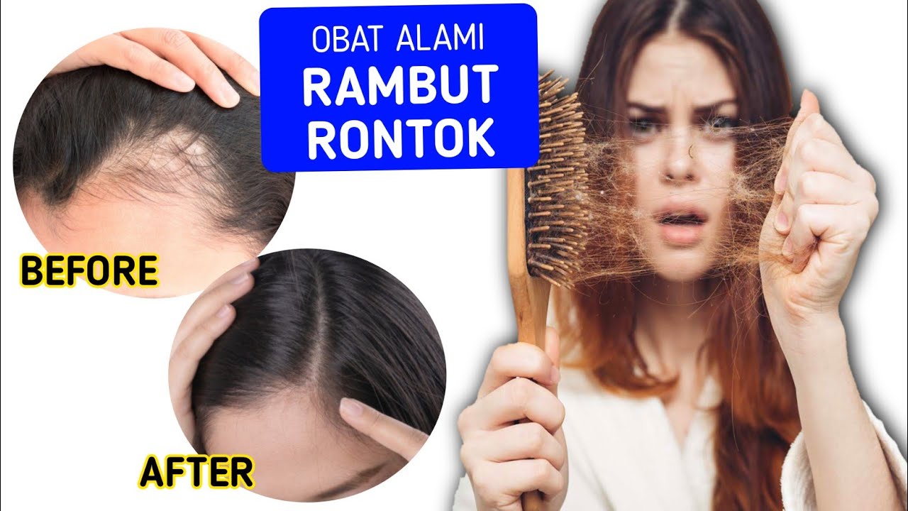 Mengapa Rambut Rontok Lebih Parah di Sekitar Dahi? Misteri yang Sering Bikin Panik