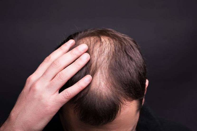 Rambut Rontok di Ujung? Jangan Panik, Ini Penyebab dan Solusi Terbaiknya!