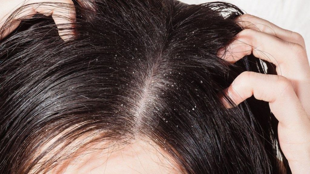 Cara Mengatasi Kulit Kepala Gatal dan Kering: 12 Langkah untuk Kesehatan Rambut