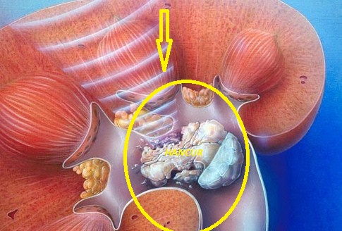 Benarkah Rambut Jagung Bisa Menghancurkan Batu Empedu? Mitos atau Fakta?