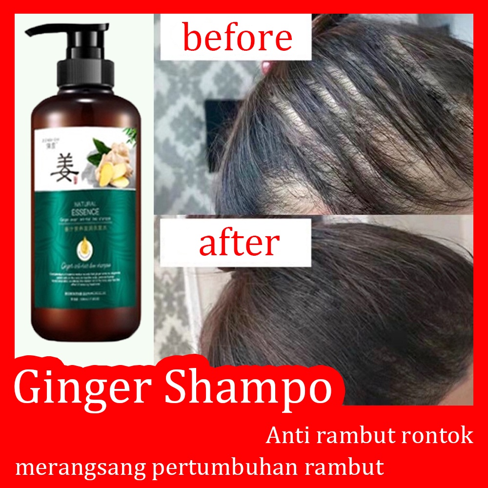 Rambut Rontok Akibat Ketombe? Atasi dengan 12 Rekomendasi Shampoo Terbaik!