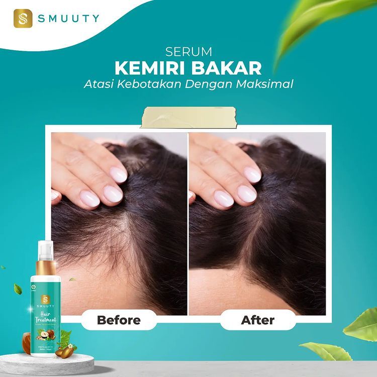 Rahasia Mengatasi Rambut Rontok Akibat Ketombe dengan Mudah