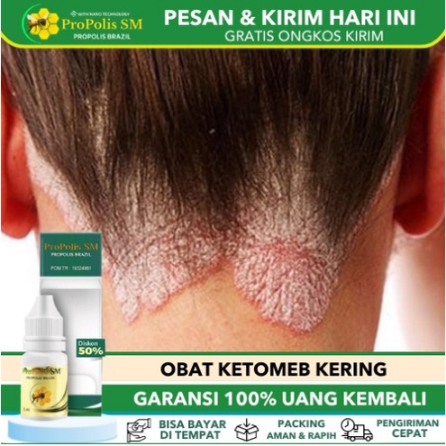 Solusi Ampuh Mengatasi Ketombe pada Rambut Kering: Atasi Permasalahan Kulit Kepala dan Kembalikan Keindahan Rambutmu!