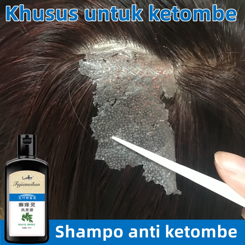 Berjuang Melawan Kulit Kepala Gatal dan Rambut Rontok? Temukan Solusi Tepat di Sini!