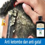 Gatal Tak Tertahankan? Atasi Ketombe dan Kulit Kepala Gatal dengan 12 Shampoo Ini!