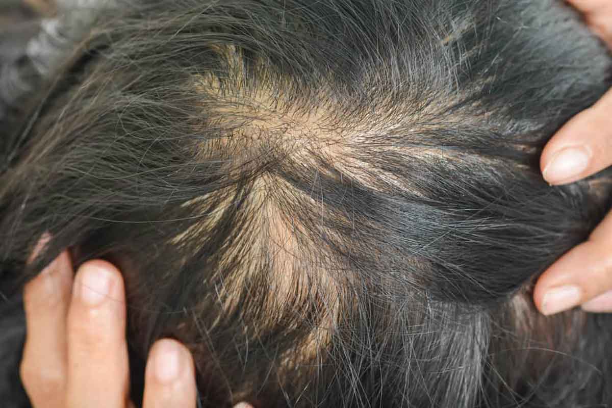 Rambut Tipis? Atasi dengan Asupan Biotin yang Tepat!