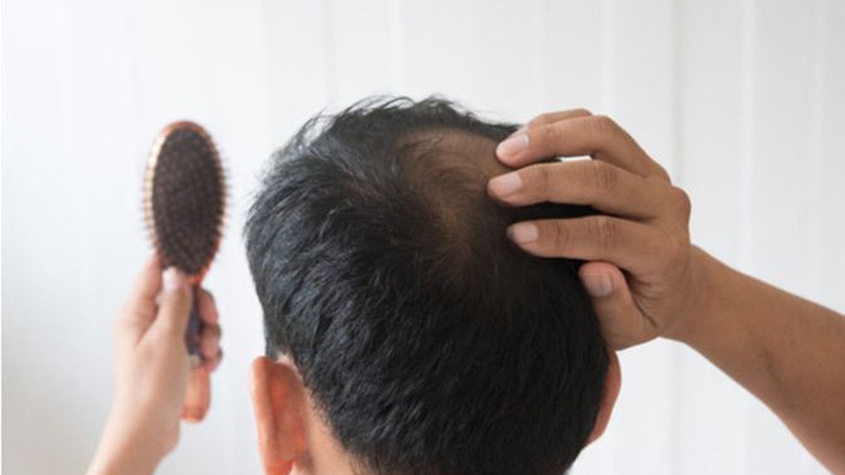 Rahasia di Balik Rambut Rontok: Mengapa Pria Lebih Rentan Kehilangan Rambut?