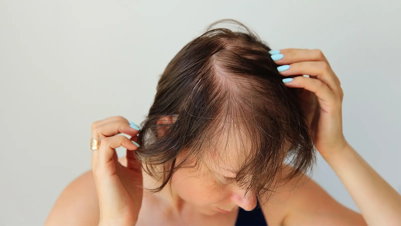 Rambut Rontok Bikin Stres? Tenang, Atasi dengan Cara Ini!