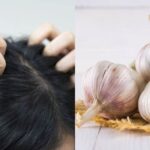 Pernahkah Kamu Merasa Gatal di Kepala dan Menemukan Bintik-bintik Putih Kecil? Waspadai, Itu Bisa Jadi Kutu Rambut!