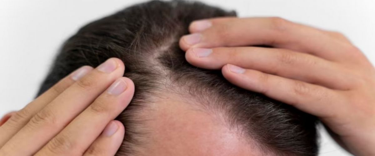 Rambut di Dahi: Mengapa Bentuknya Berbeda-beda?