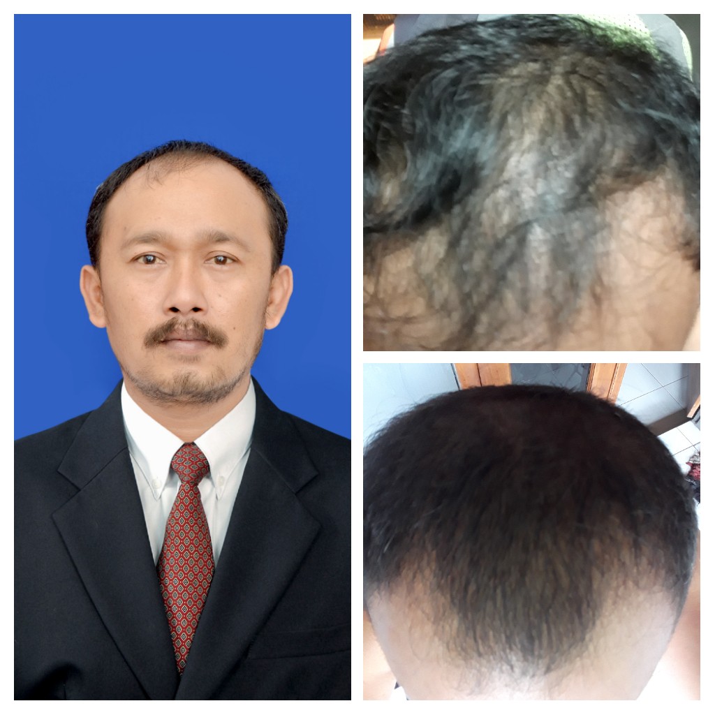 Rambut Botak Bisa Tumbuh Kembali? Mengungkap Rahasia di Balik Kebotakan