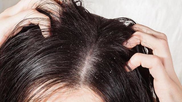 Rambut Rontok di Usia Remaja: Jangan Panik, Yuk Kenali Penyebabnya!