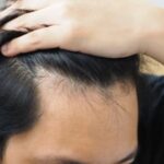 Rambut Rontok, Takdir atau Solusi?