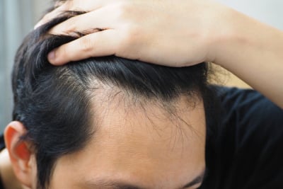 Rambut Rontok, Takdir atau Solusi?