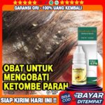 Atasi Ketombe Membandel Dengan Masker Rambut Alami Yang Efektif