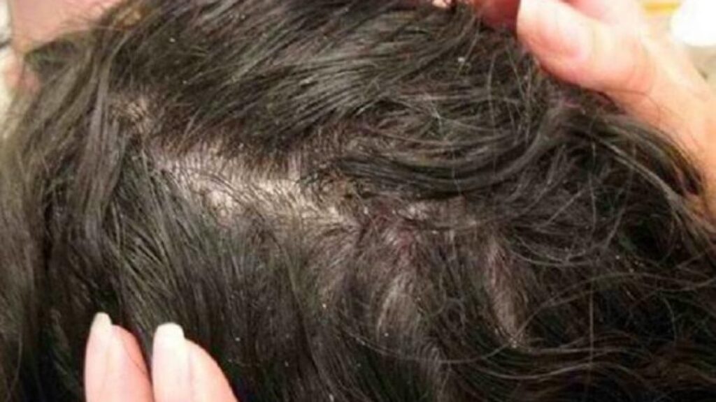 Hilangkan Kutu Rambut dengan Teh Hijau: Cara Alami yang Ampuh dan Praktis