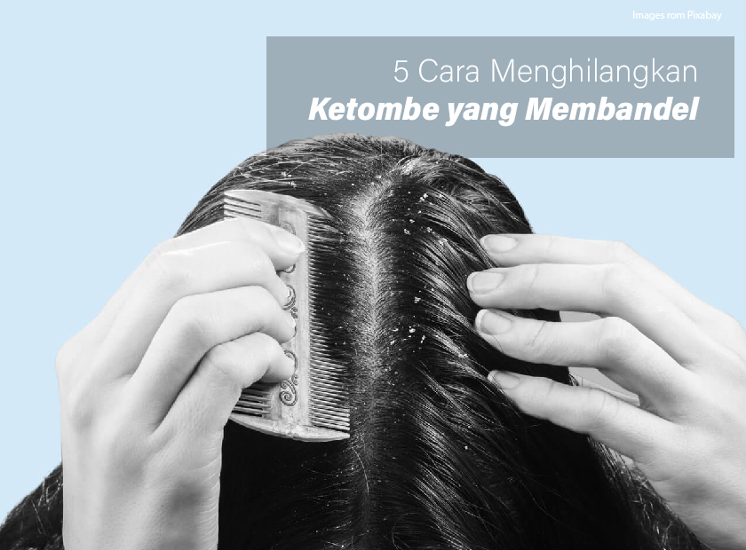 Pernahkah Kamu Merasakan Ketombe yang Membandel? Kenali Penyebabnya dan Atasi dengan Cara yang Tepat!