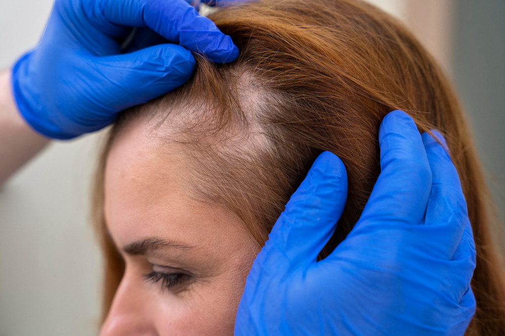 Rambut Rontok? Jangan Panik! Solusi Mengatasi Kebotakan pada Wanita