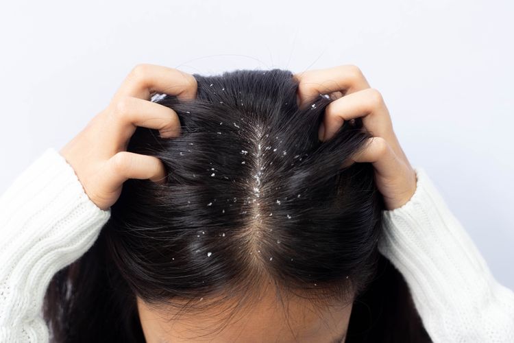 Rambut Berminyak dan Ketombe Basah: Kenapa Terjadi dan Bagaimana Mengatasinya?