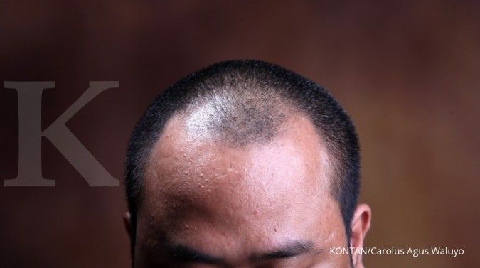 Apakah Rambut Rontok Bisa Tumbuh Kembali? Panduan Lengkap untuk Memulihkan Rambut Anda