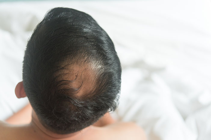 Rambut Botak Tengah: Mengungkap Rahasia Kehilangan Rambut di Area Tengah Kepala