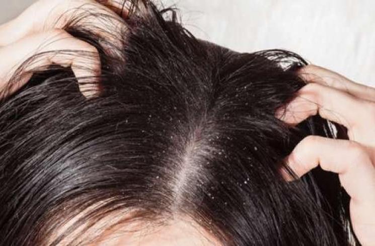 Apakah Rambut Berketombe Bisa Disembuhkan?