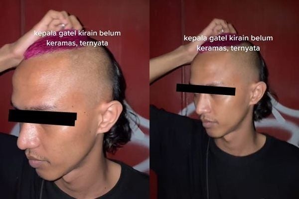 Rambut Putih, Bikin Gatal? Mitos atau Fakta?