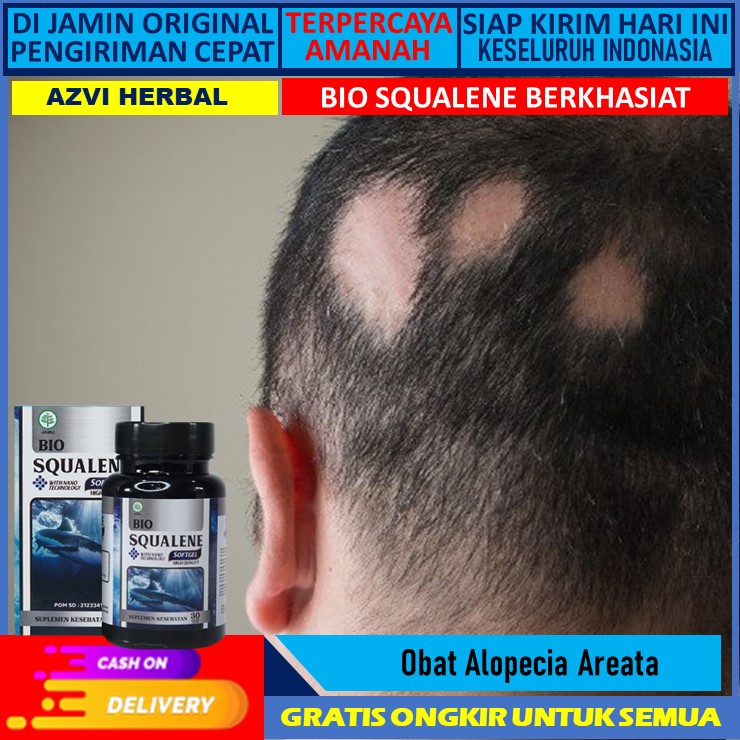 Hilangkan Pitak Akibat Alopecia Areata: Panduan Lengkap Menuju Rambut Sehat Kembali