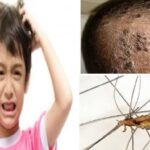 Bagaimana Bisa Ada Kutu di Rambut? Misteri yang Sering Bikin Gatal!