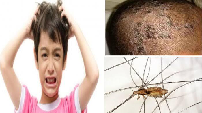 Bagaimana Bisa Ada Kutu di Rambut? Misteri yang Sering Bikin Gatal!