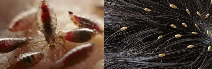 Mengusir Kutu Rambut dengan Minyak Kayu Putih: Benarkah Efektif?