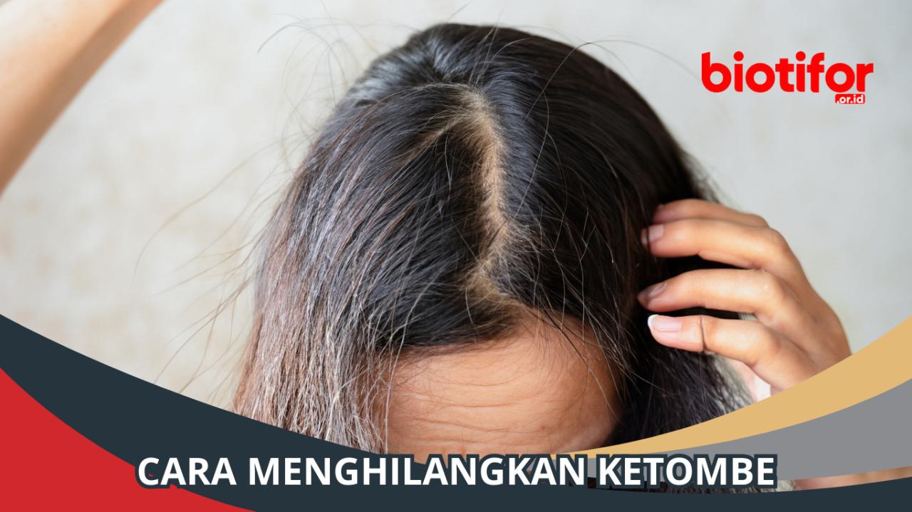 Rambutmu Berketombe? Jangan Panik! Atasi dengan Tips Jitu Ini, Walau Hormonmu Berulah!