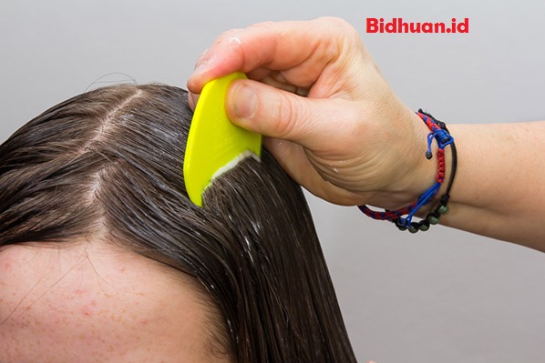 Cara Menghilangkan Kutu Rambut dengan Lemon: Solusi Alami yang Efektif?